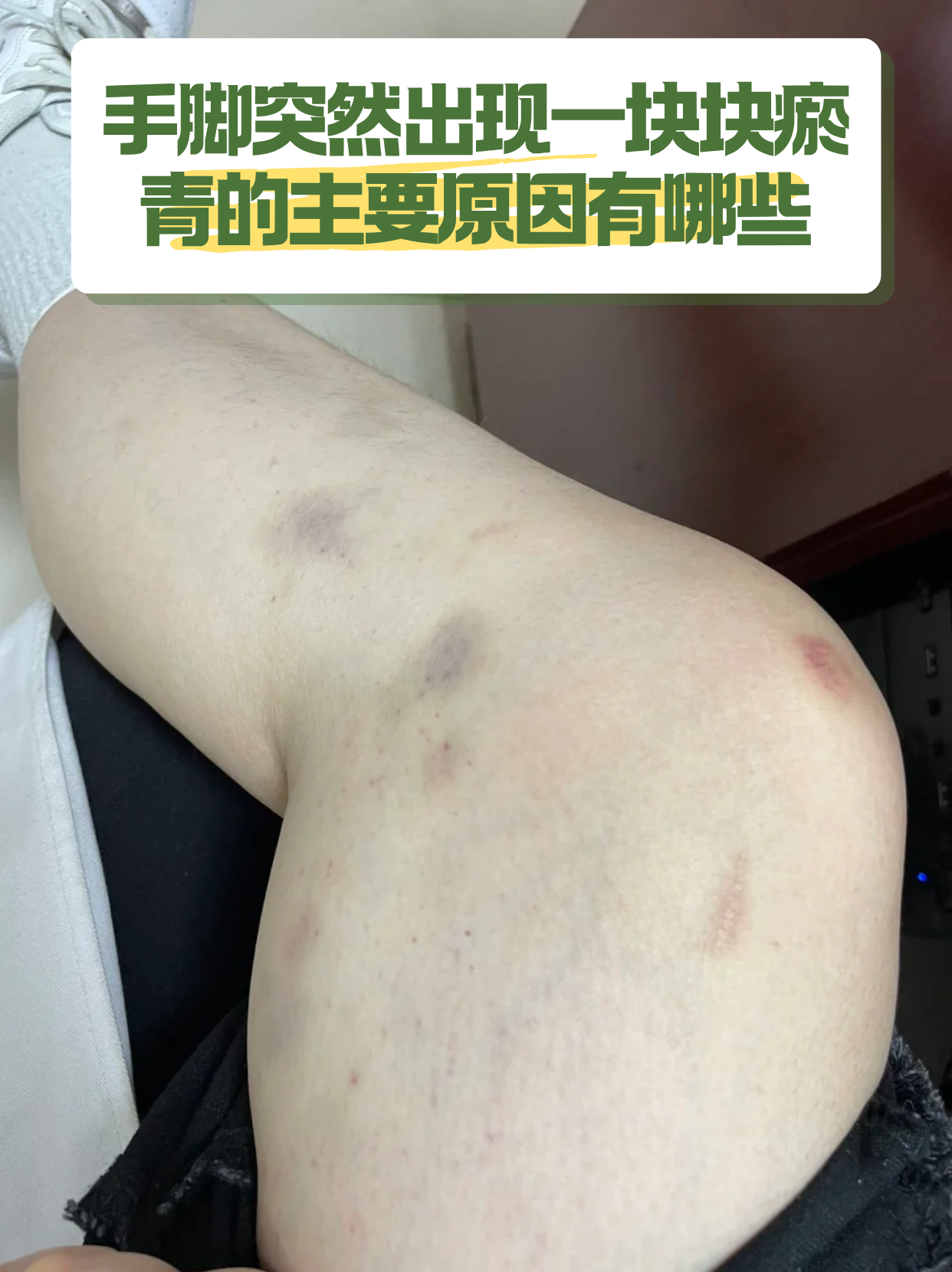 黑青怎么回事正常瘀斑图片严重手脚突然出现一块块瘀青主要原因有哪些