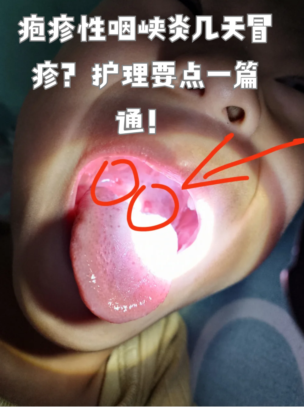 嗓子起疱疹图片喉咙有白色脓包是什么咽峡炎疱 疱疹性咽峡炎几天冒疹?