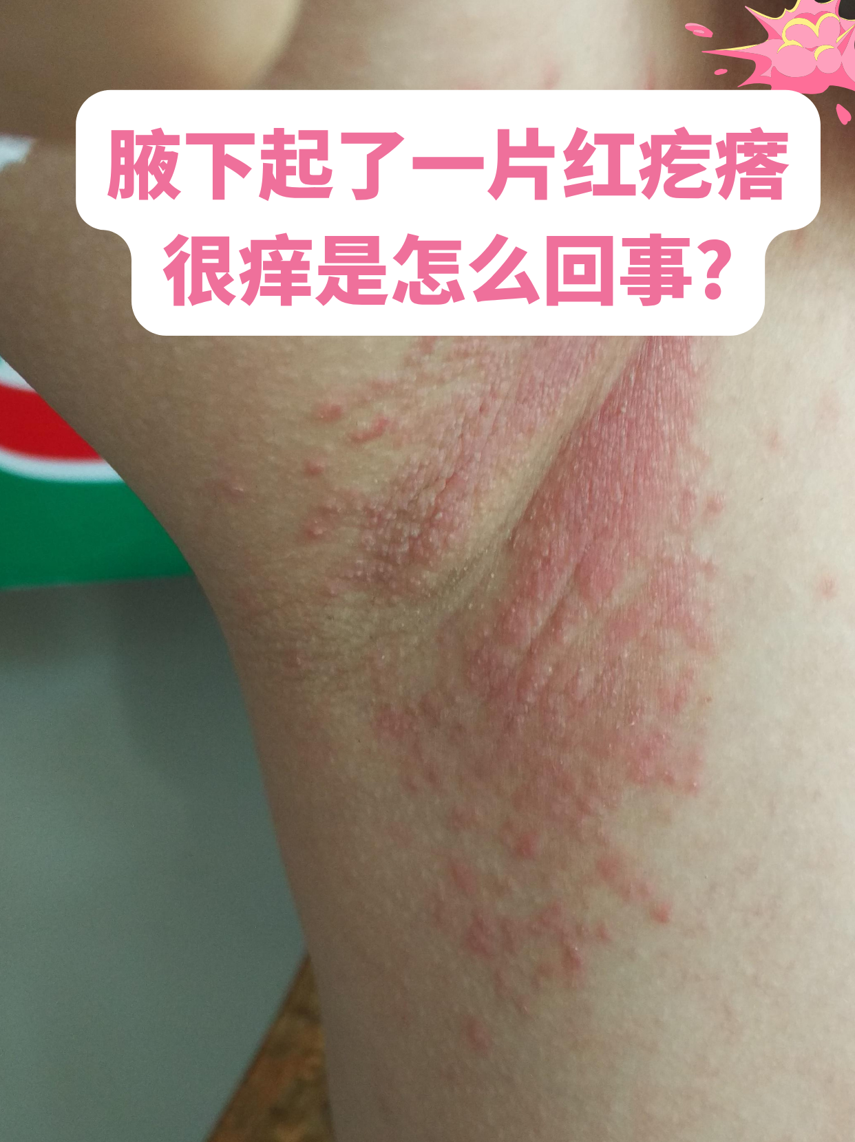 为什么腋窝老是出汗