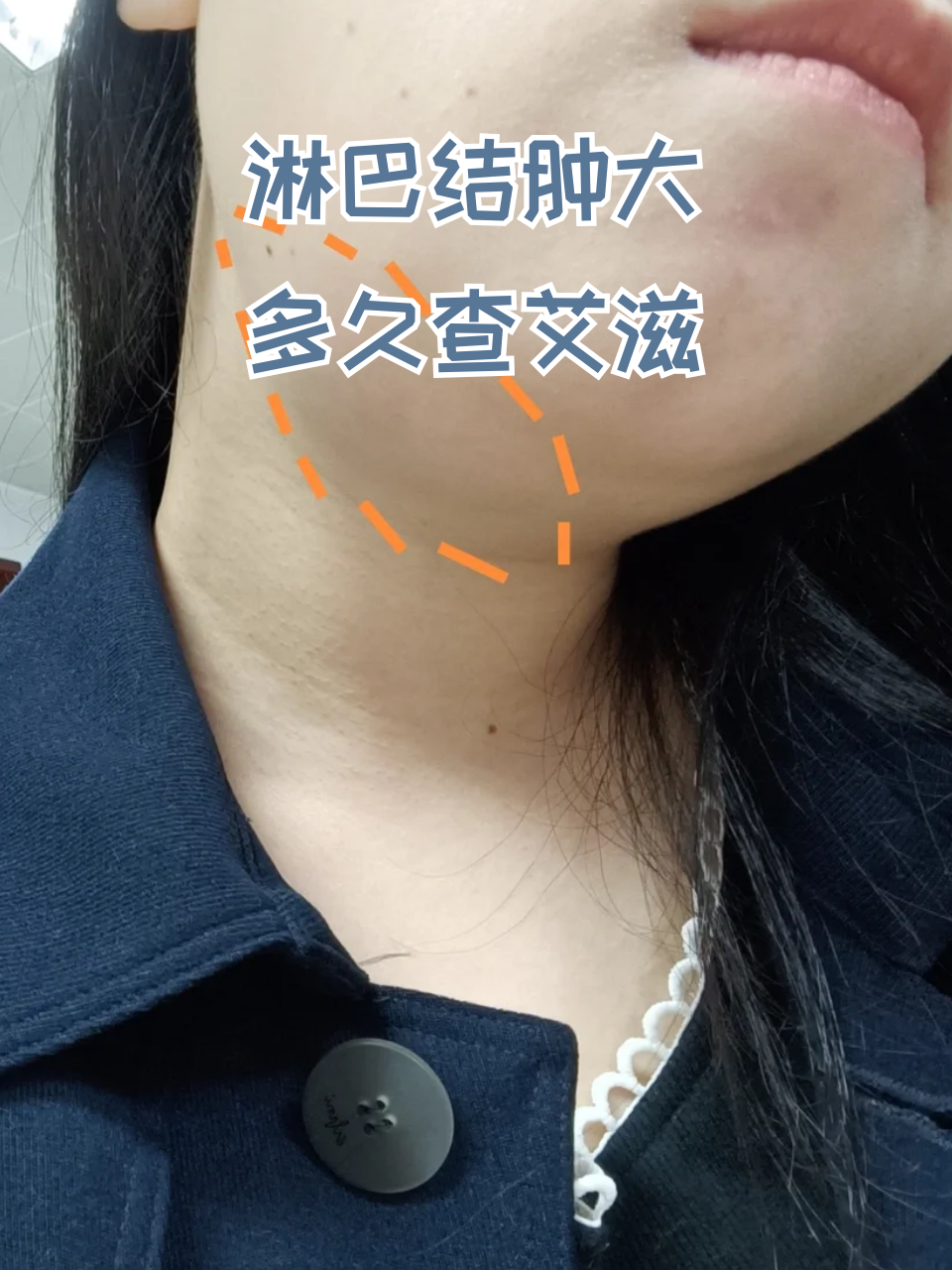 淋巴结肿大多久查艾滋