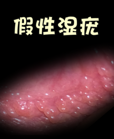 假性湿疣和尖锐湿疣症状像吗