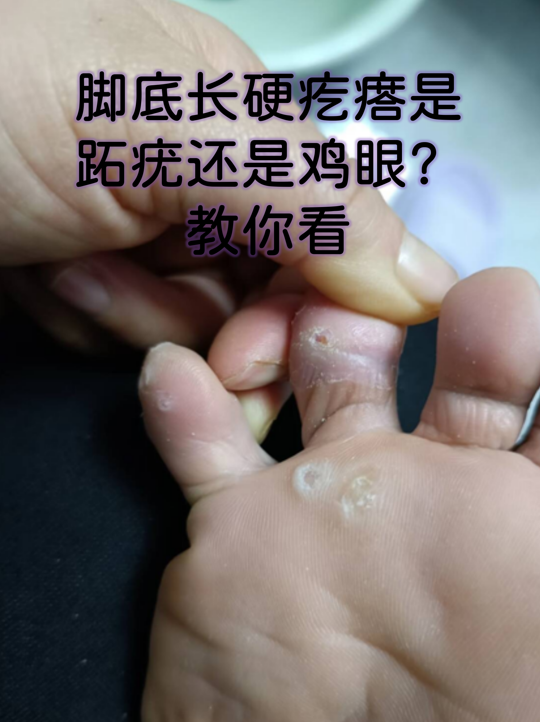 脚底长硬疙瘩是跖疣还是鸡眼?