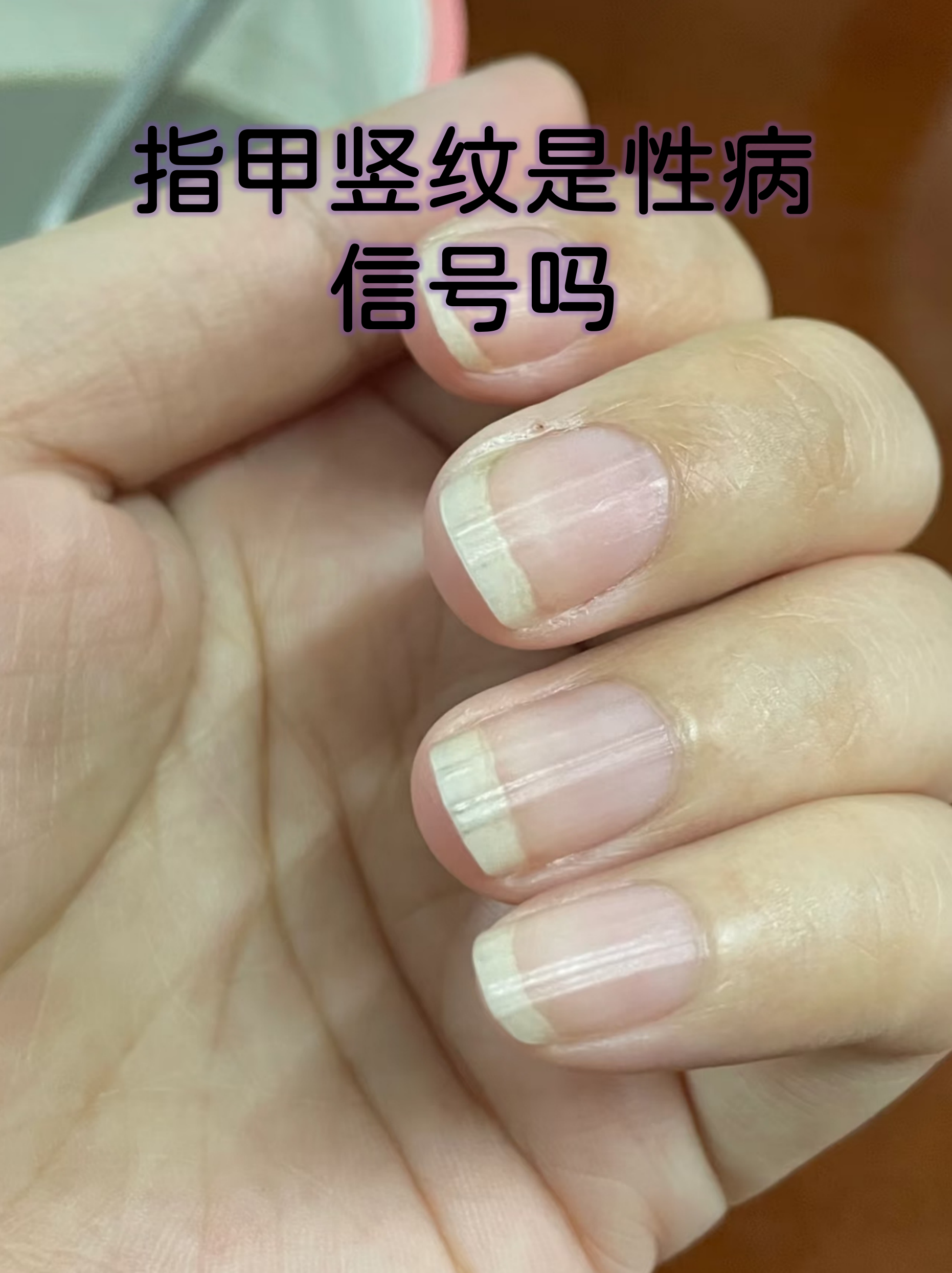 指甲出现竖纹在生活中很常见,许多人误以为是