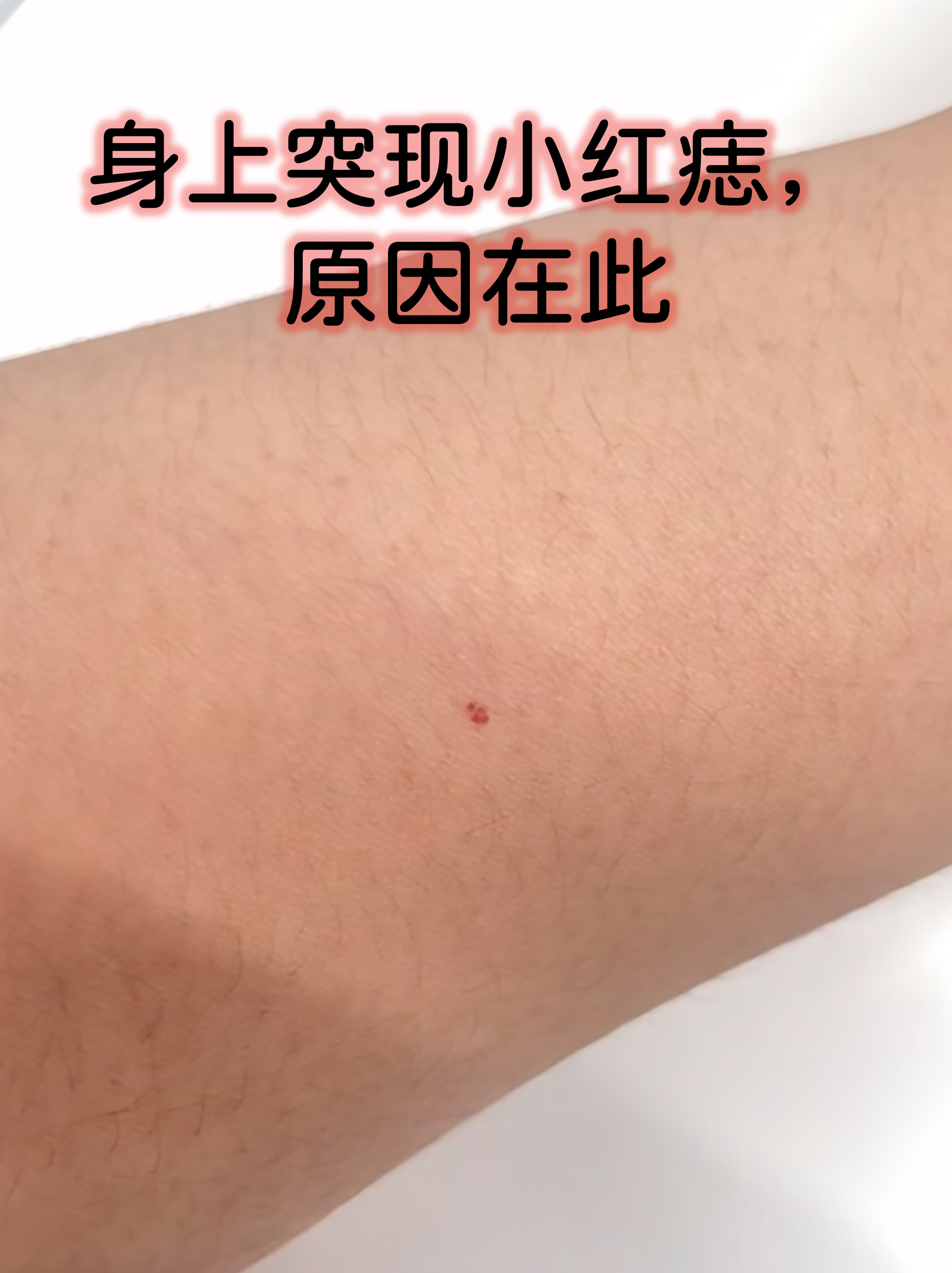 痣的成因多样,从皮肤老化到潜在疾病都可能有关,今天我们就来详细 治 