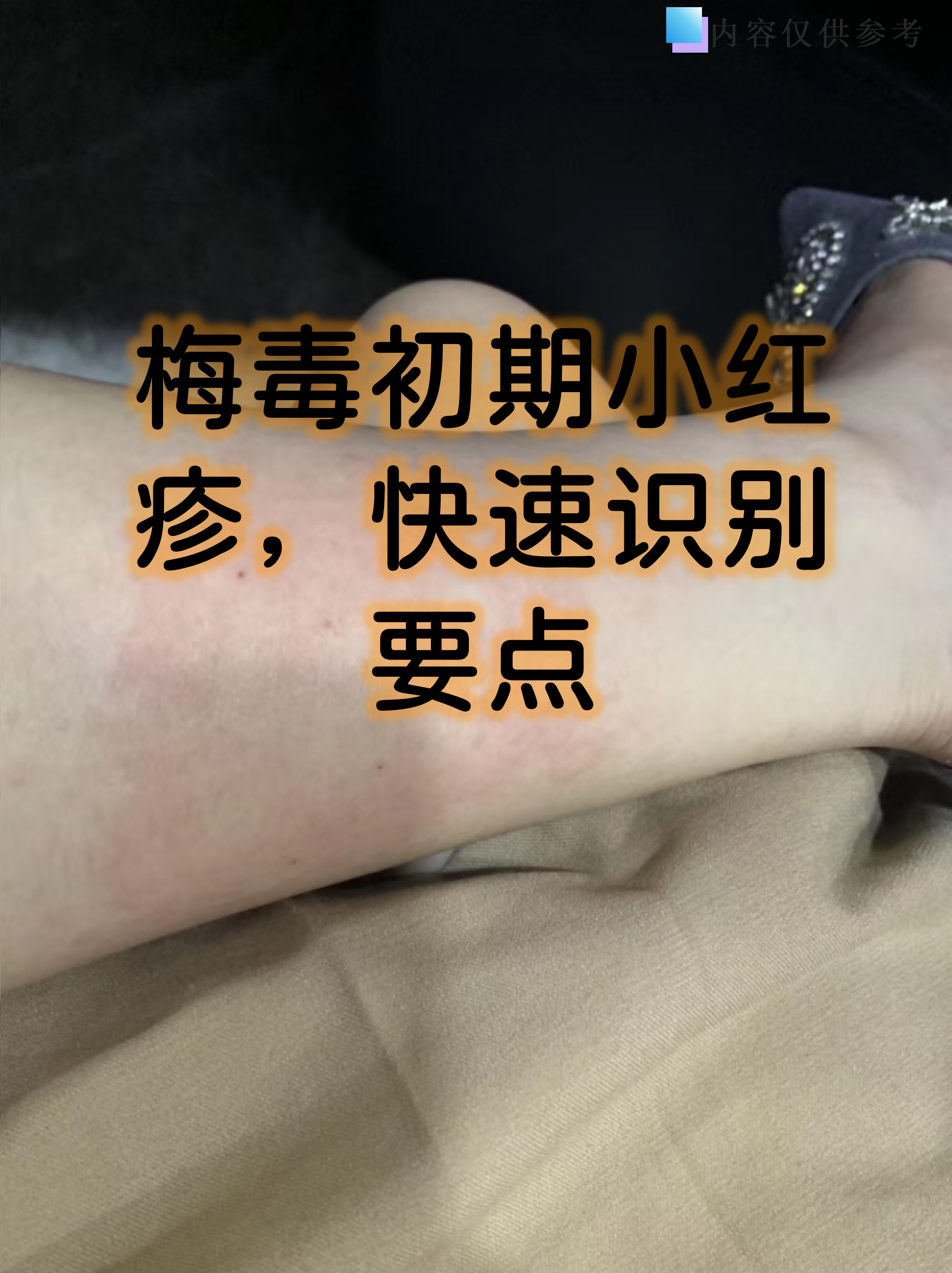 梅毒初期小红疹,快速识别要点