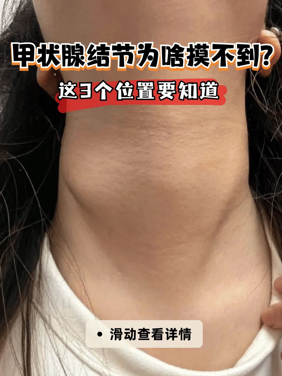 脖子不舒服想自查甲状腺结节,却怎么也摸不到?