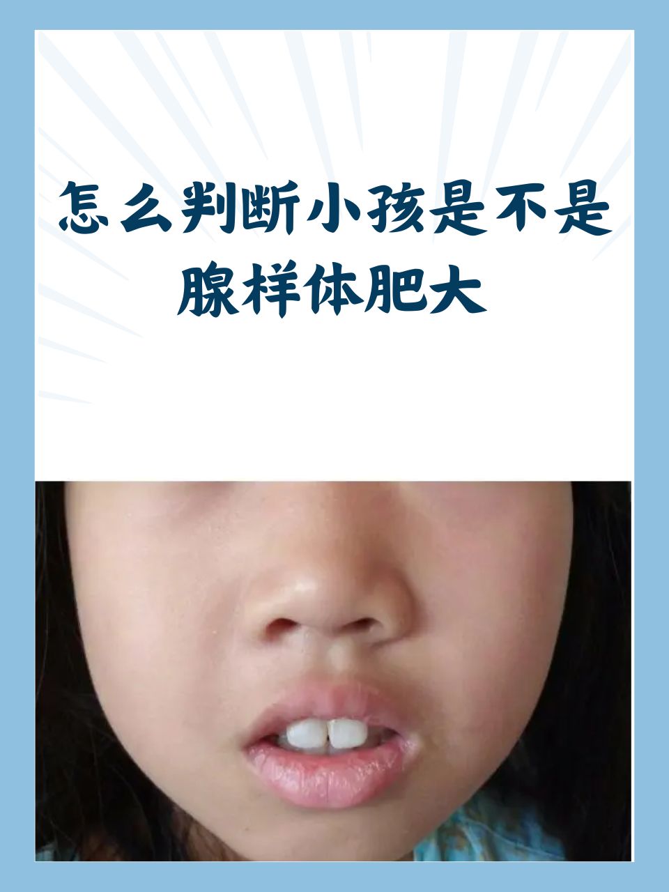 怎么判断小孩是不是腺样体肥大  腺样体肥大是儿童常见的健康问题