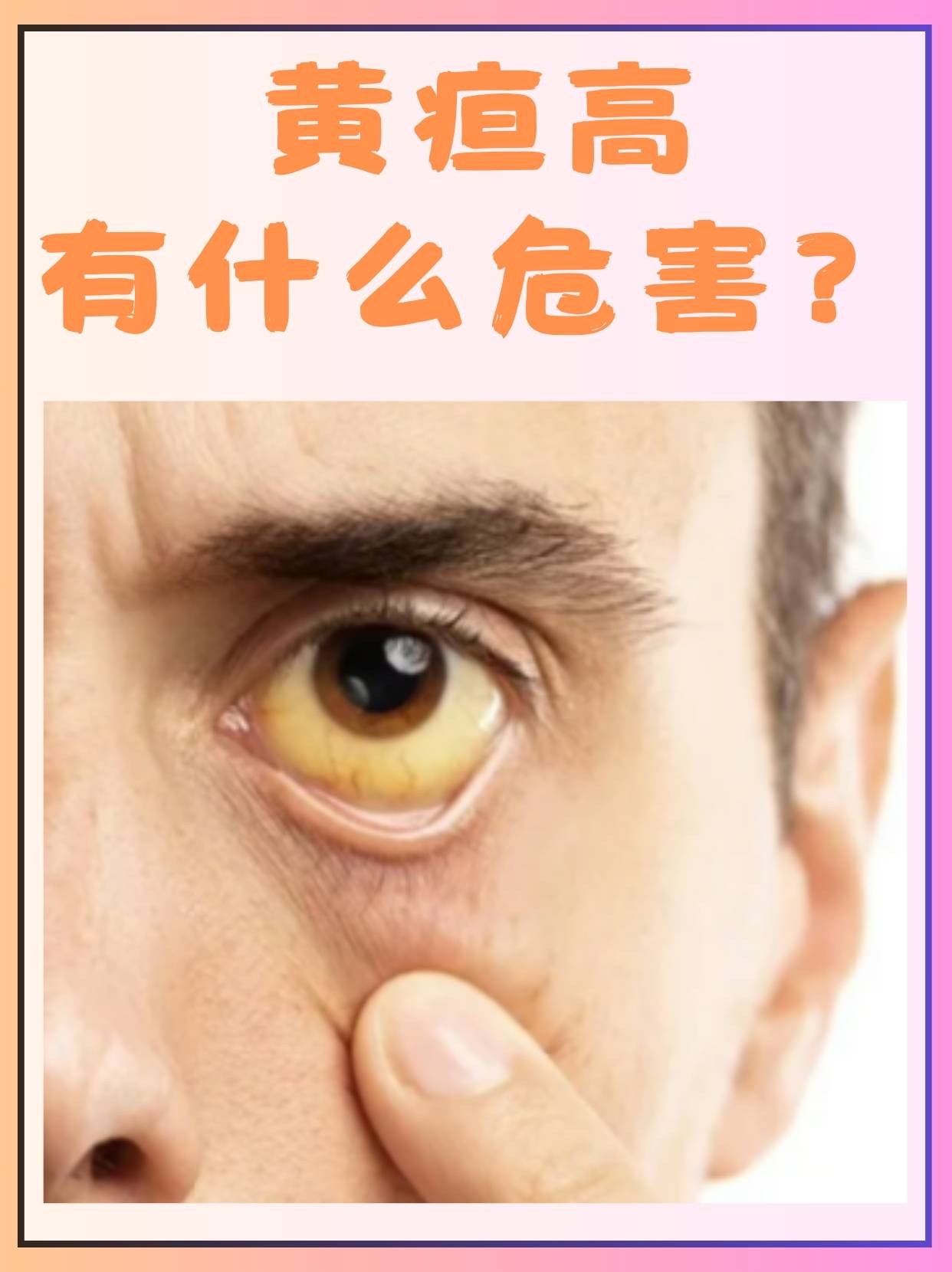 黄疸高有什么危害  黄疸这一新生儿及成人中常见的症状,往往让人心生