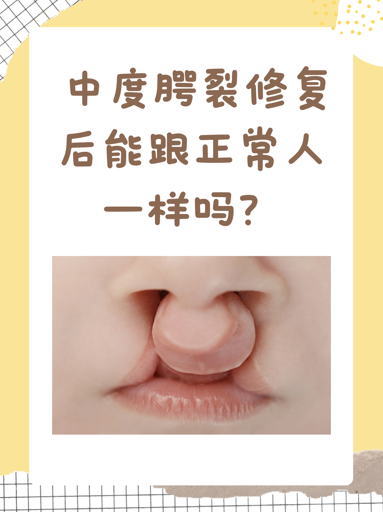 中度腭裂修复后能跟正常人一样吗?