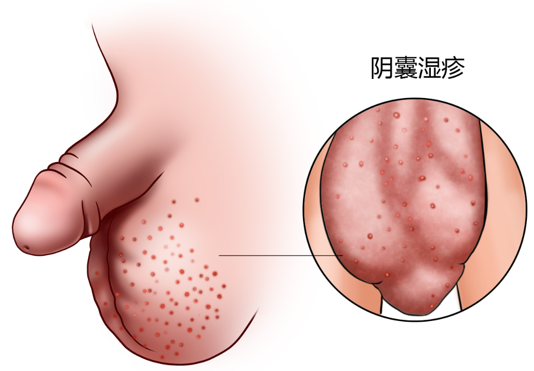 生活护理全攻略 阴囊湿疹是一种常见的皮肤炎症,主要表现为阴囊部位的