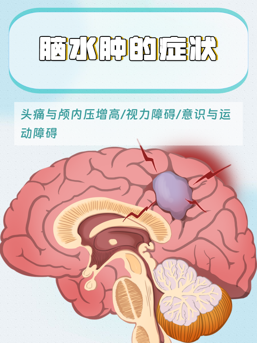 脑水肿的症状?