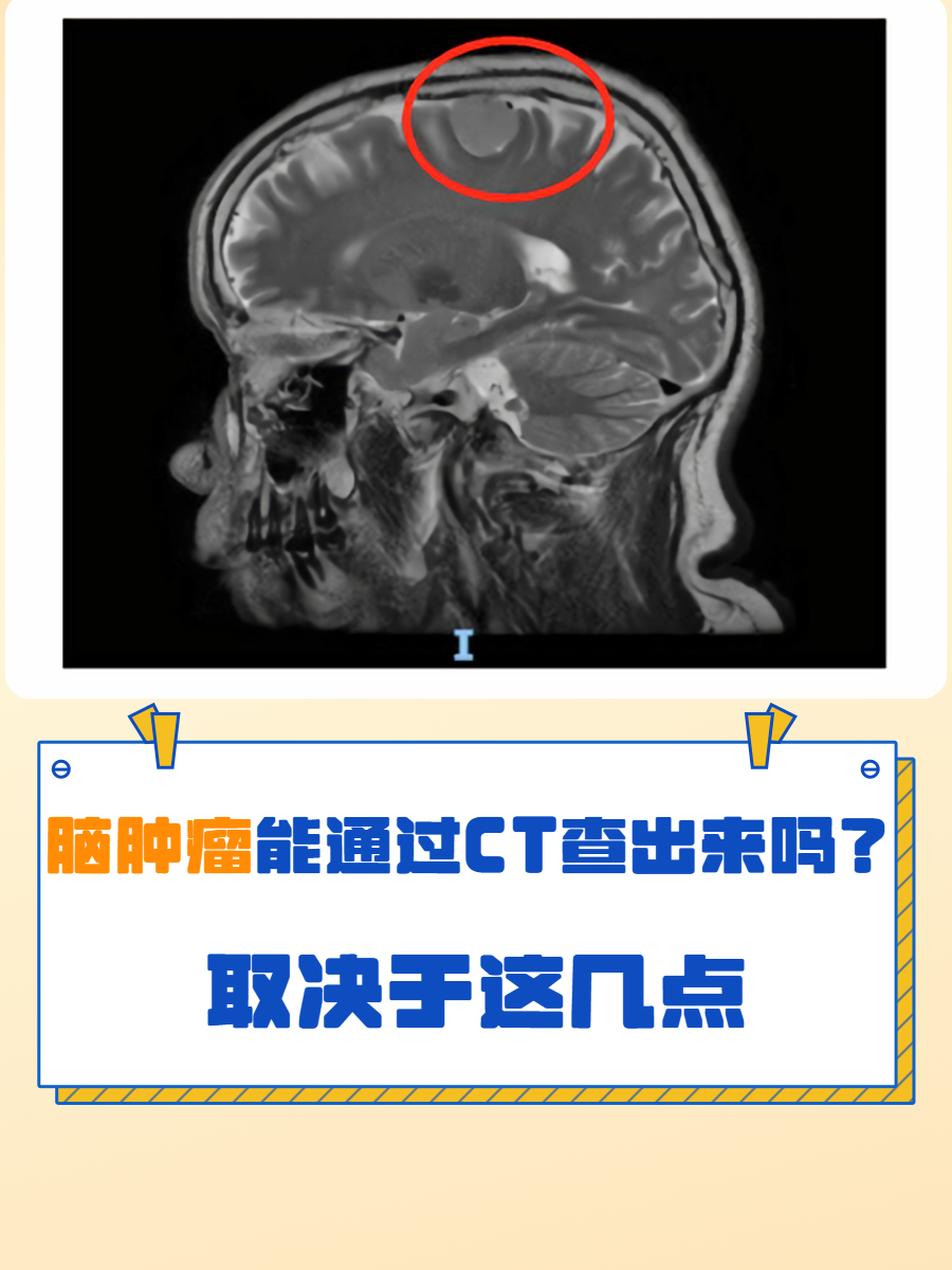 这个问题的答案,与脑肿瘤的大小,位置和性质密切脑肿瘤ct图片脑部肿瘤