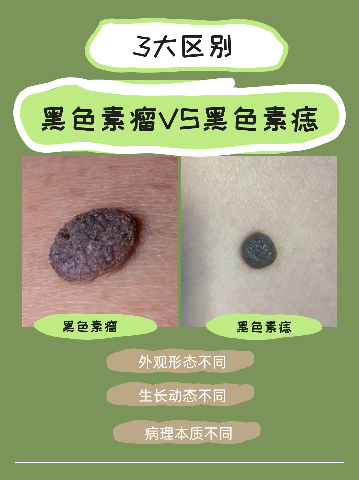 黑色素肿瘤和黑色素痣的区别:3个关键区别点分享 黑色素肿瘤一般指黑