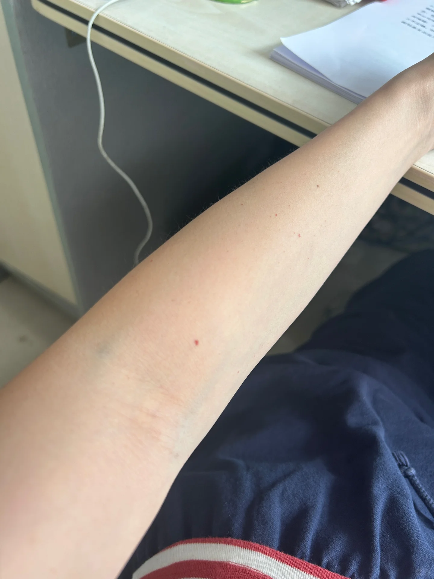 紫癜早期胳膊红点图片过敏性紫癜痒吗皮肤过敏性手臂长小红点该怎么办
