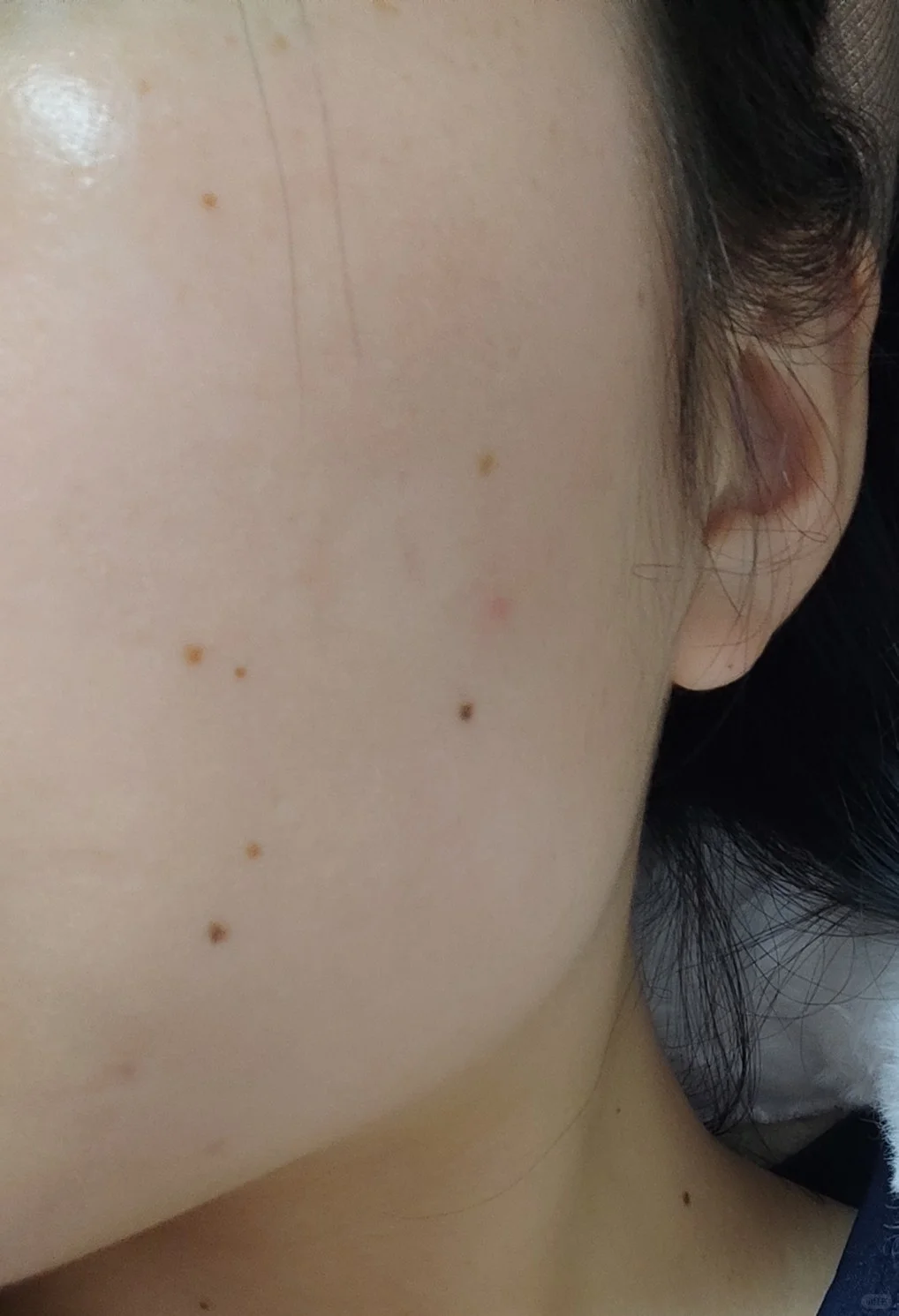 这5种变化需要立即就医 脸上长痣越长越大需留意,出现5种变化时建议
