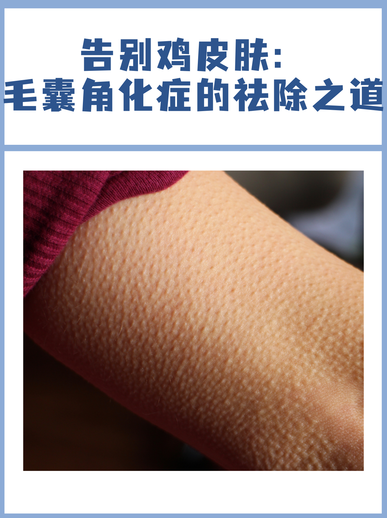 告别鸡皮肤:毛囊角化症的祛除之道[比分] 毛囊角化症是一种常见的皮肤