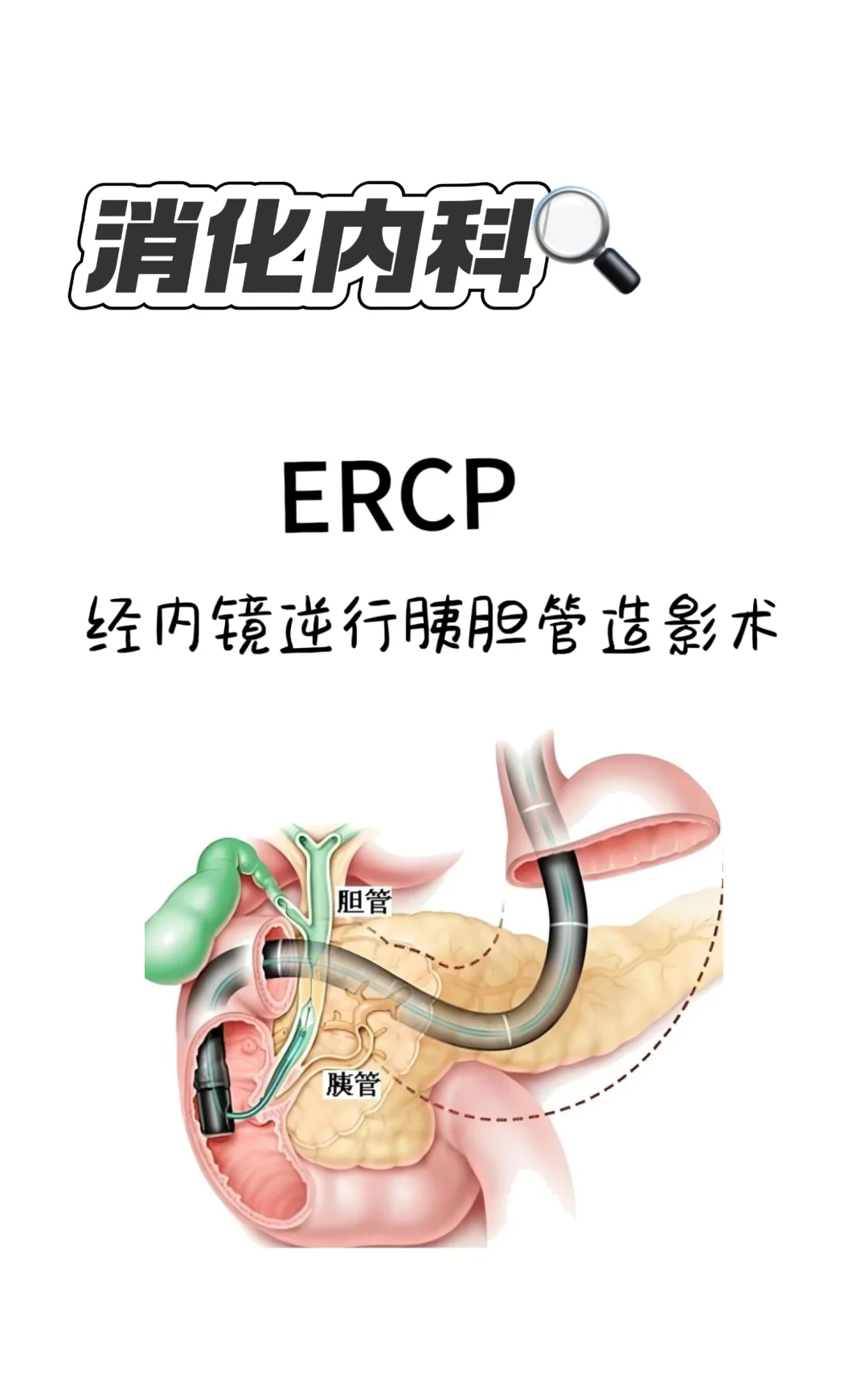 图片胆总管造影胰胆管胰腺副胰管开口mrcp高清图