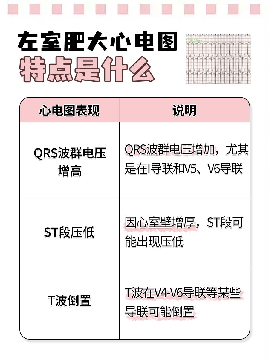左室肥大心电图特点详解:识别心脏疾病信号 左室肥大是一种常见的心脏