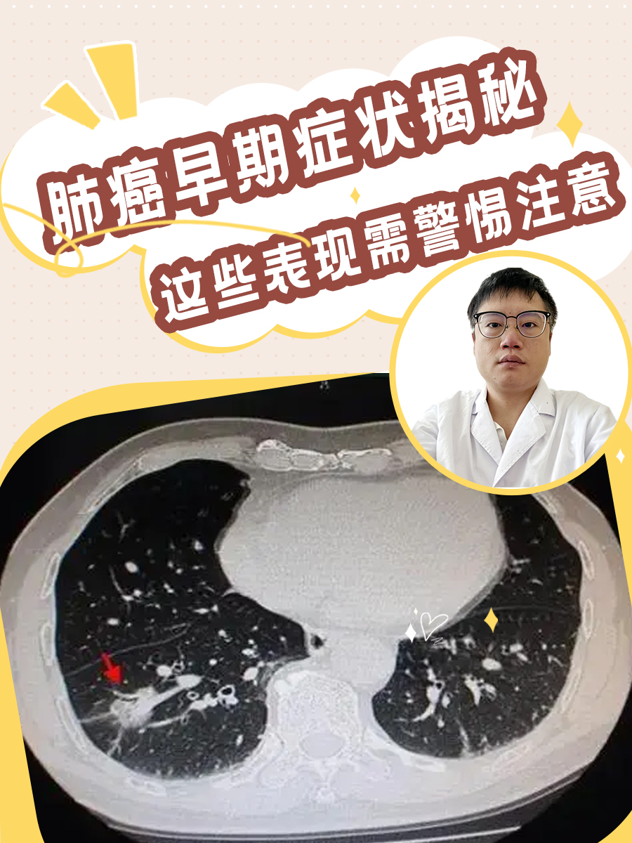 了解肺癌的症状,对于早期发现和及时治疗至关重要.