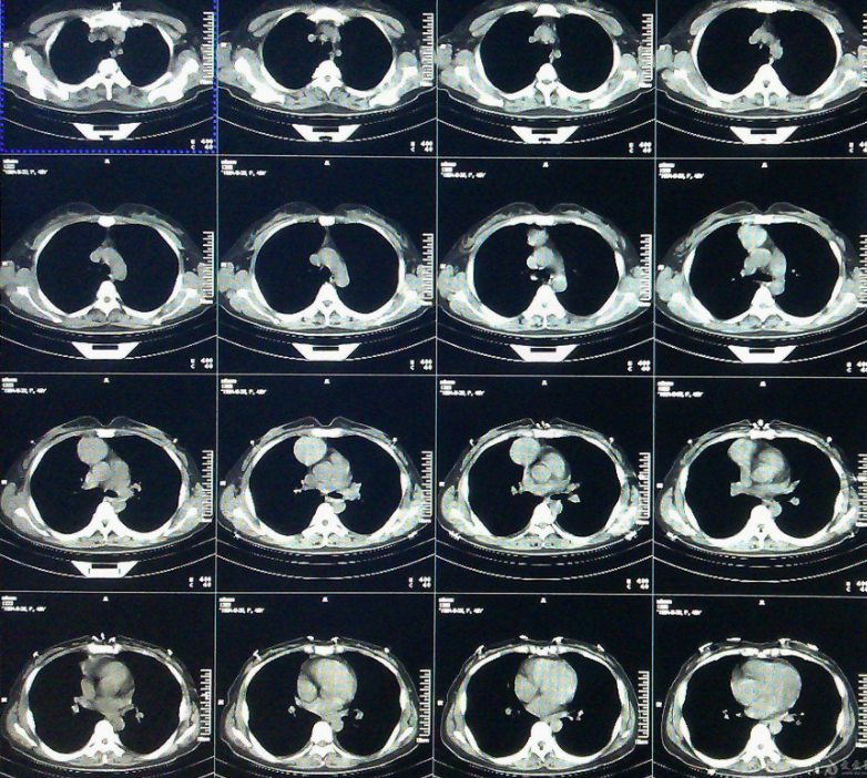北醫六院CT加急-北醫六院ct加急核酸檢測 