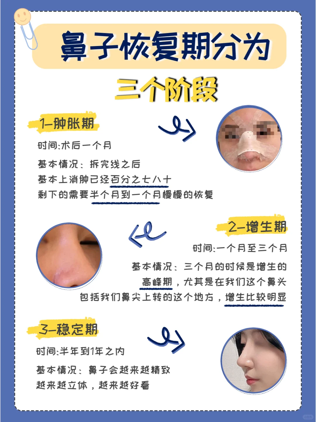 增生怎么办鼻尖肿大怎么办隆鼻后鼻头变硬怎么处理鼻子整形做手术多久