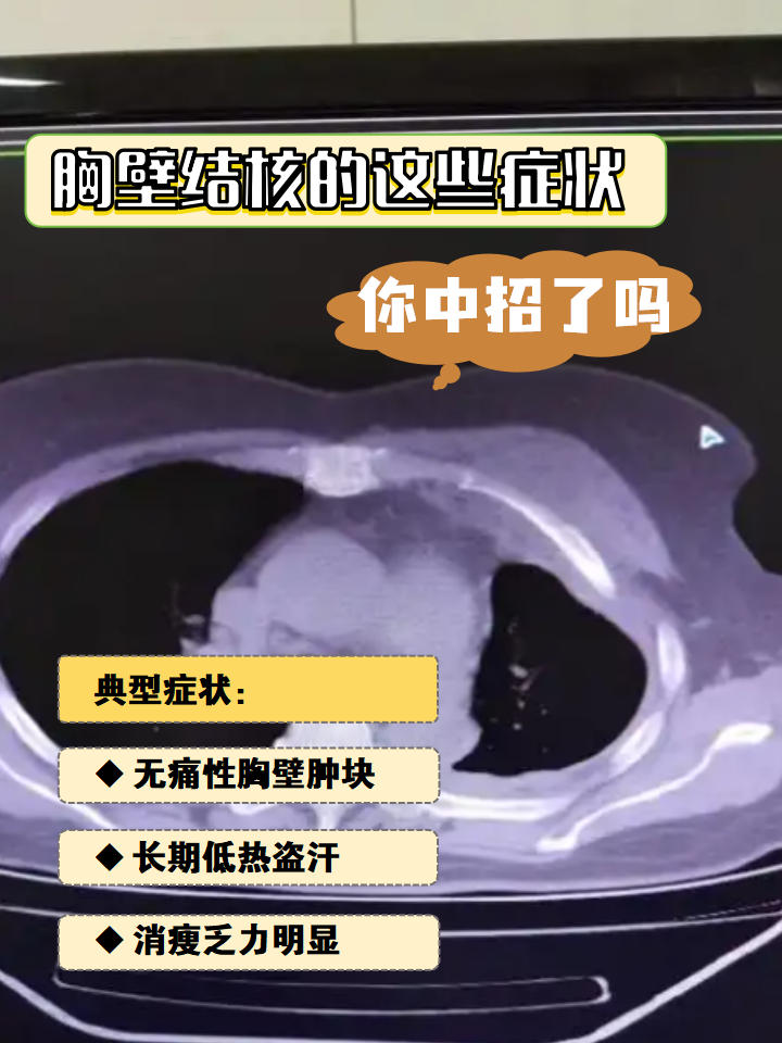 胸壁结核的这些症状,你中招了吗