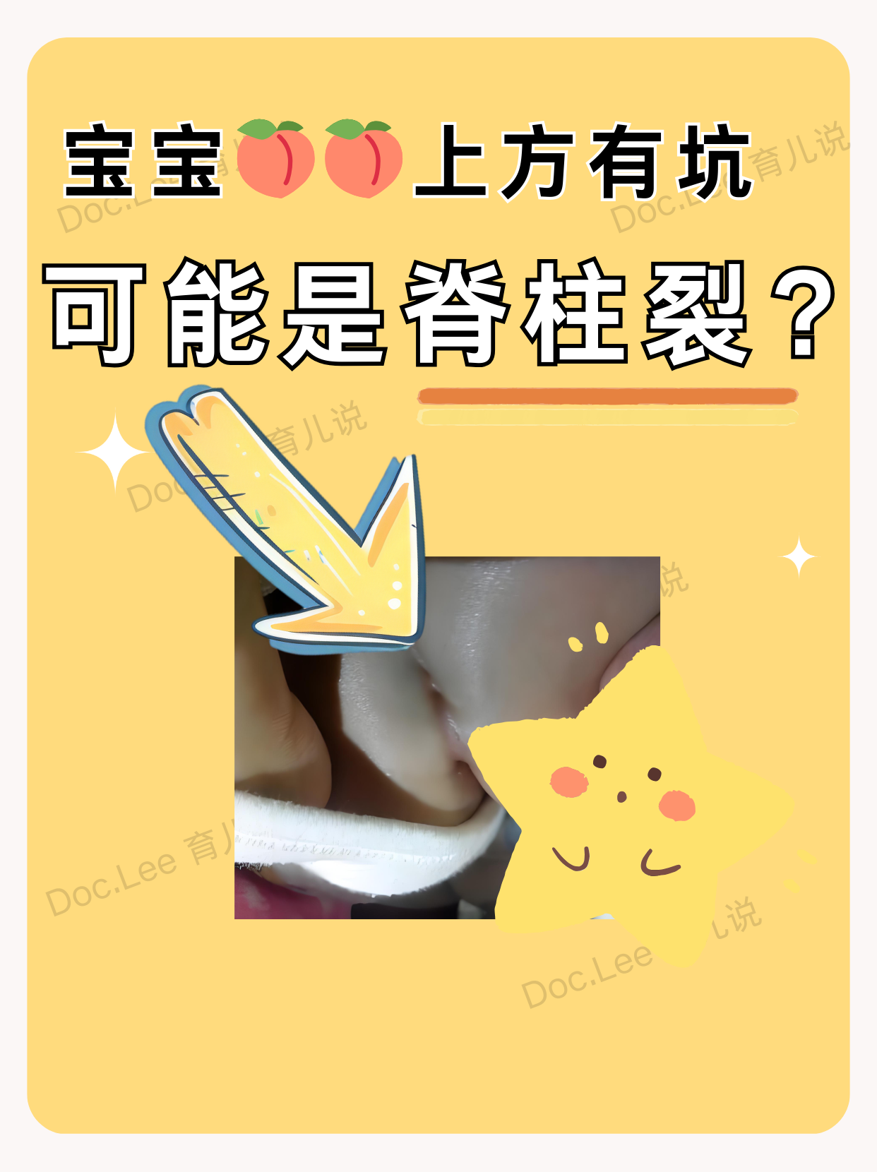 脊柱裂的症状图片隐性脊柱裂长毛图片脊柱裂图片脊柱裂几种图片新生儿