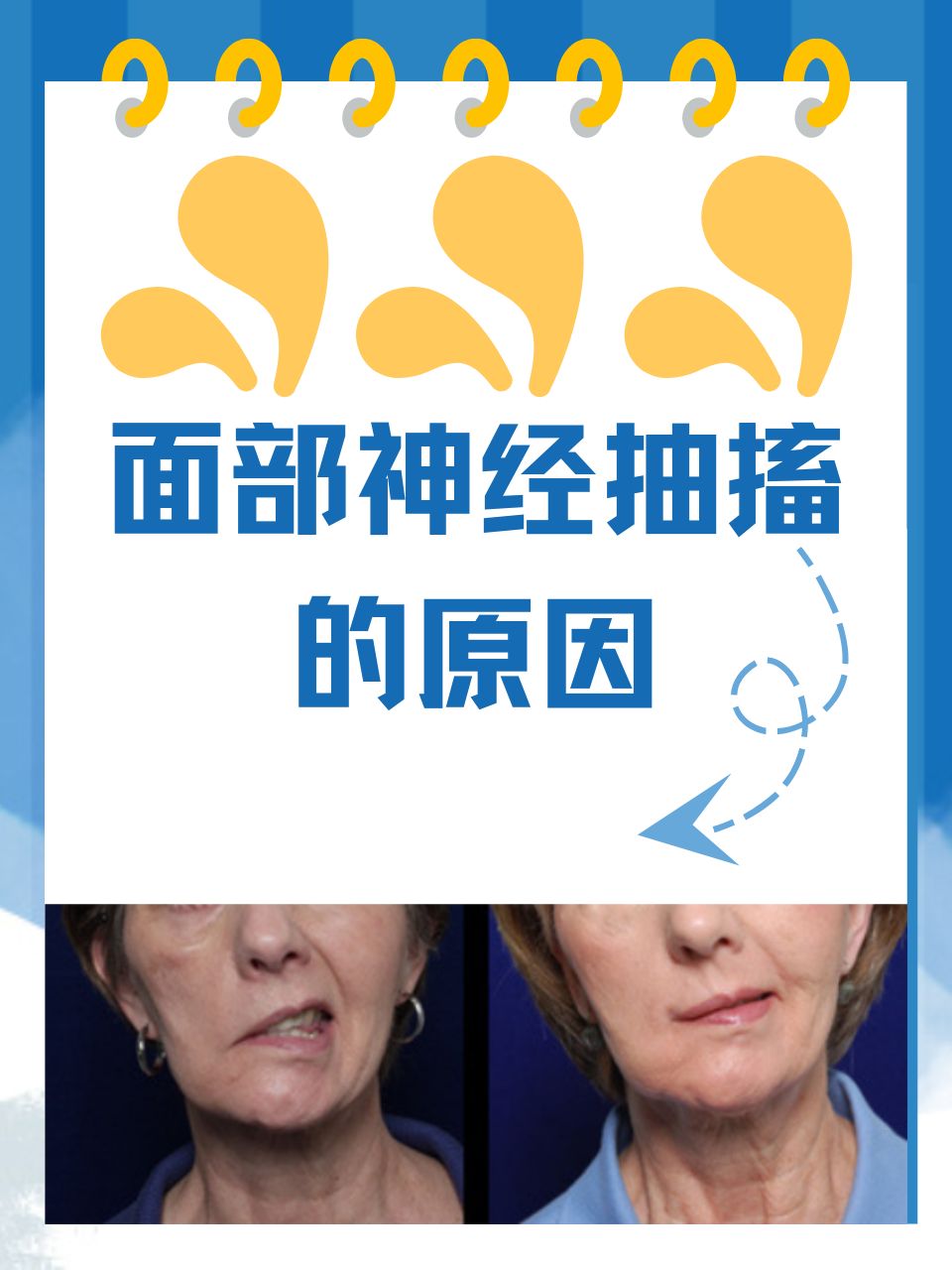 那么,面部神经抽搐究竟是由什么原因引起的呢?又该如何应对呢?