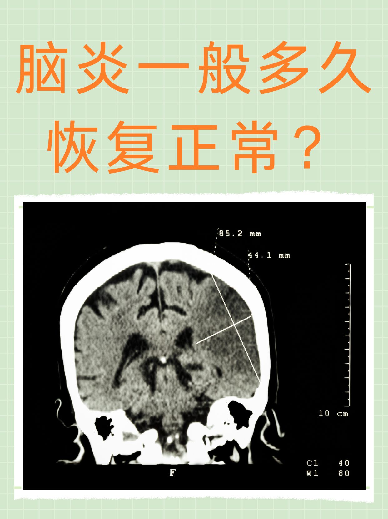 膜炎脑炎后遗症脑膜刺激征脑炎症状表现小儿脑炎图片脑炎病变常累及