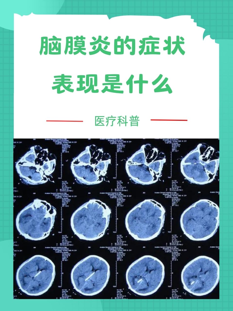 脑膜炎症状多样,一般有发热,头痛,呕吐等