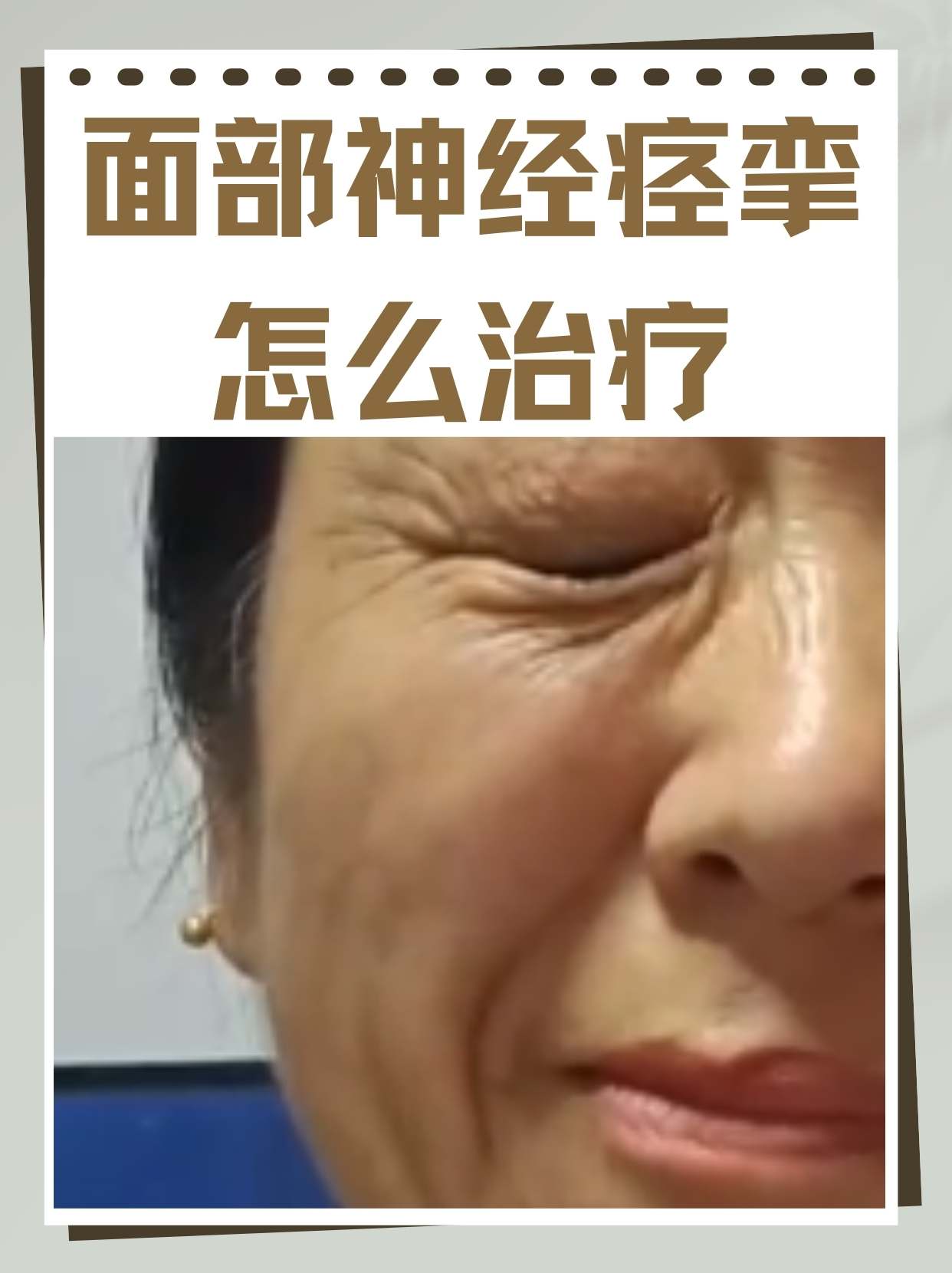 面部神经痉挛怎么治疗  面部神经痉挛,也被称为面肌痉挛,是一种常见的