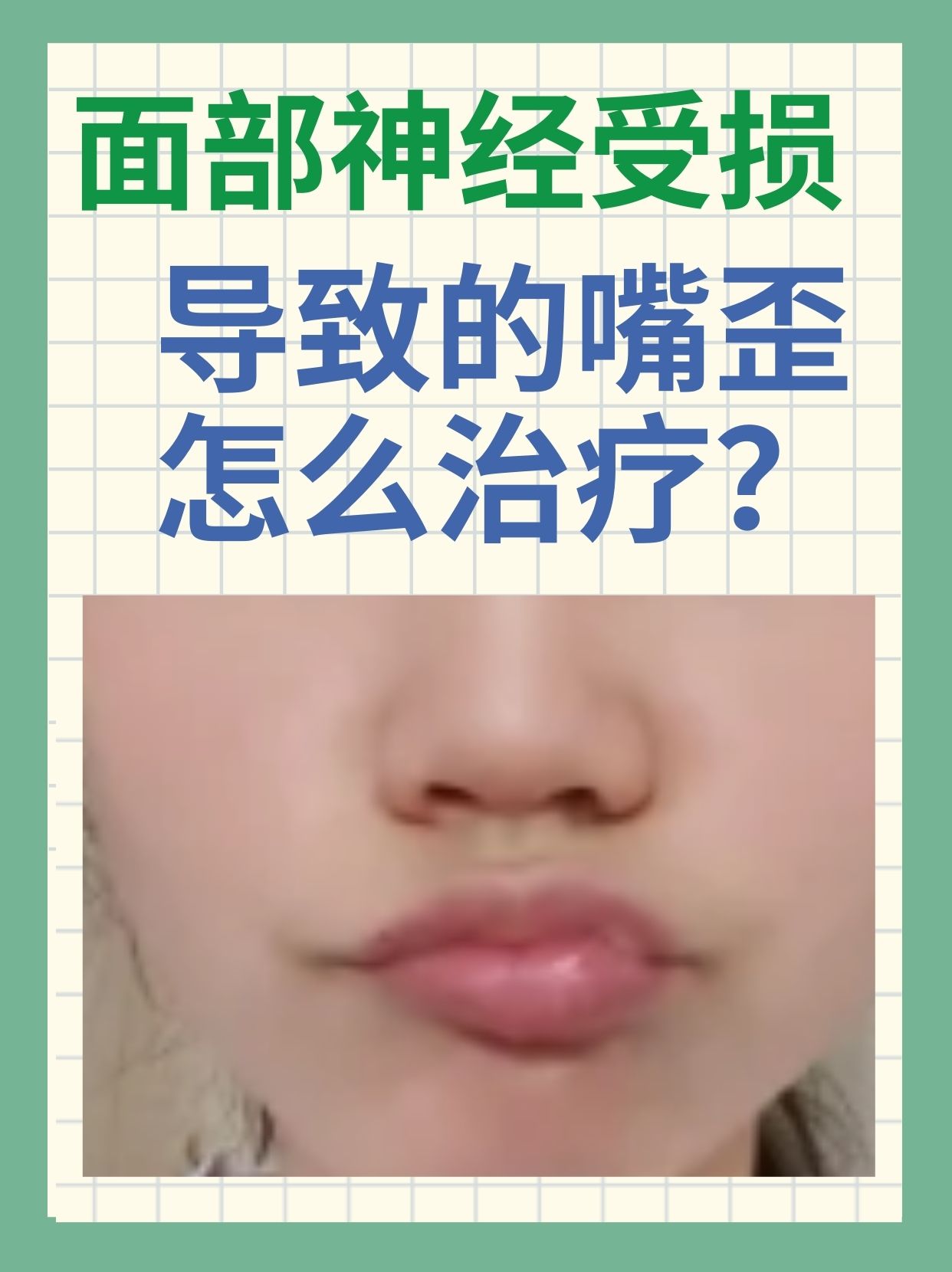 在生活中,突然发现面部神经导致嘴歪,会让人十分惊慌
