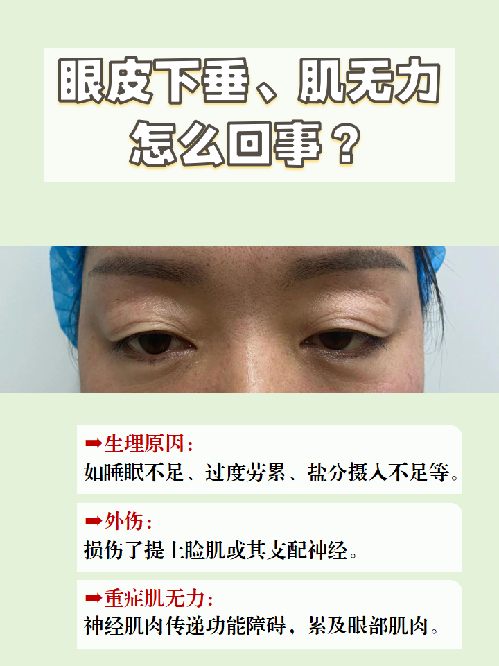 当出现眼皮下垂,肌无力时,我们眼睛会变得一大一小,这很影响个人的