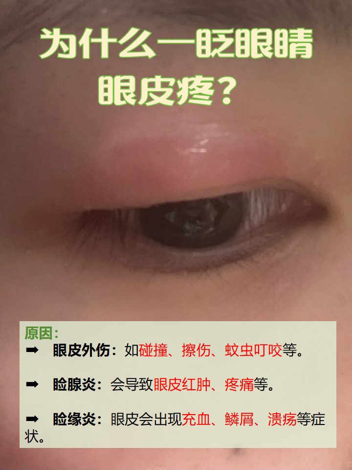 眼部健康|为什么一眨眼睛眼皮疼?