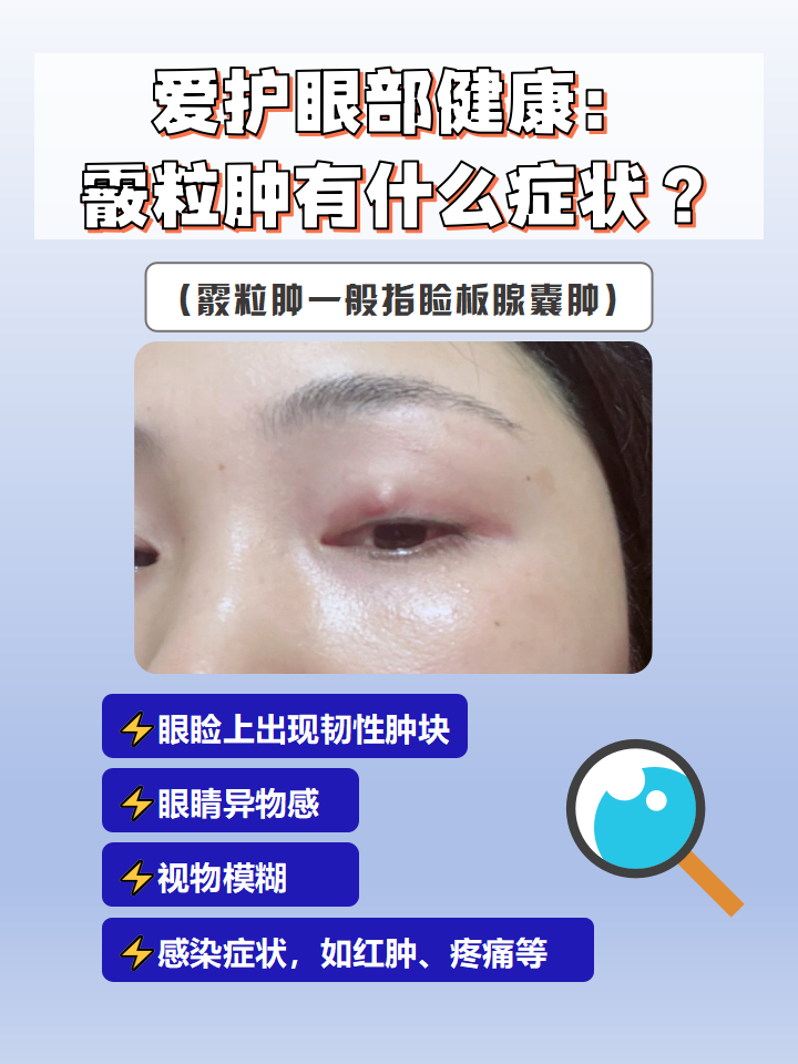 霰粒肿一般指睑板腺囊肿,它是一种睑板腺慢性非化脓性炎症