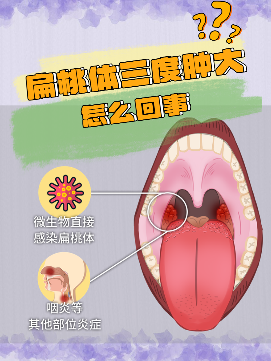 扁桃体三度肿大图解图片