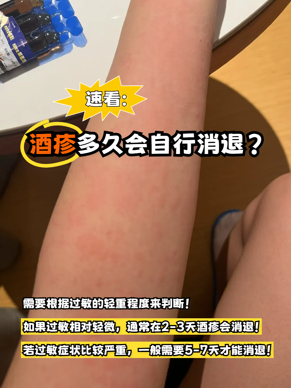 它其实就是喝酒后,对酒精过敏引起的,那出现酒疹后,多久可以自行消退