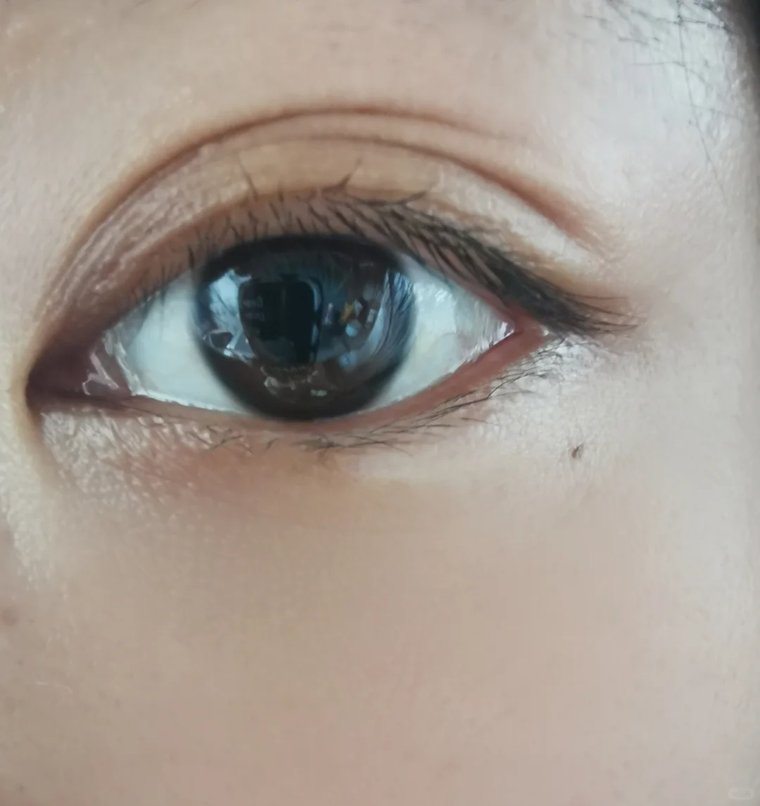 眼睛发蓝可能提示缺铁性贫血,身体缺铁影响巩膜发育