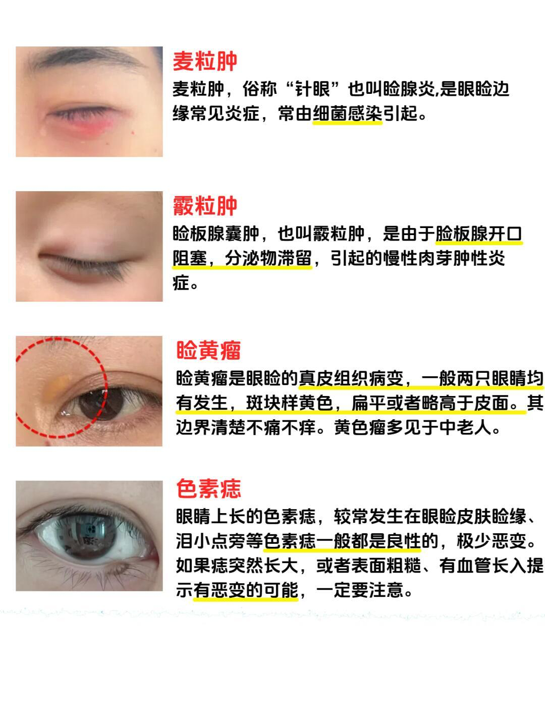 眼皮上长凸起小疙瘩,可能是麦粒肿,多因细菌感染引起;也可能是