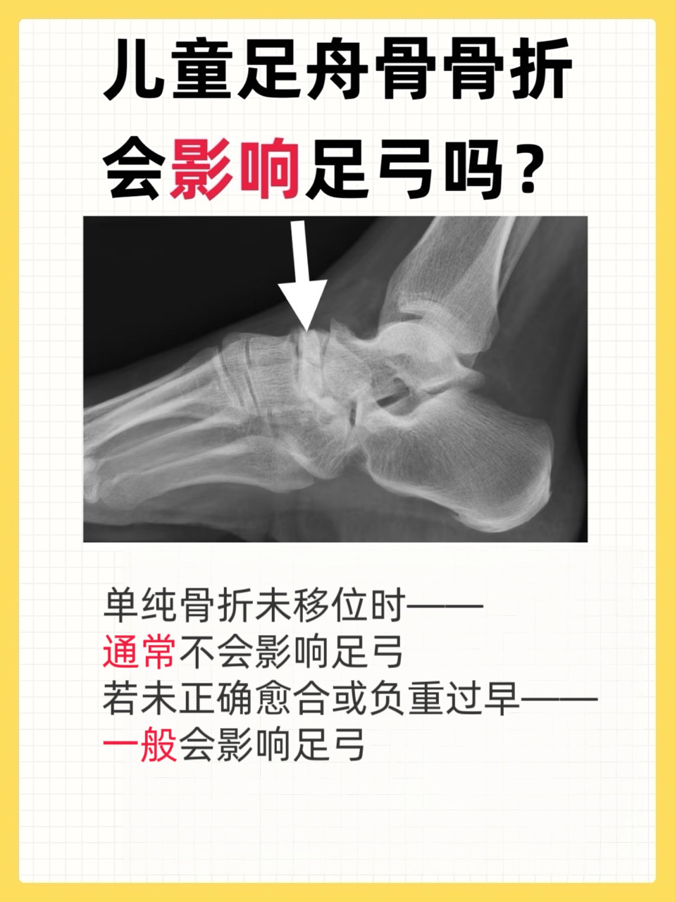 足舟骨骨折后,很多家长担心足弓变形.别焦虑!