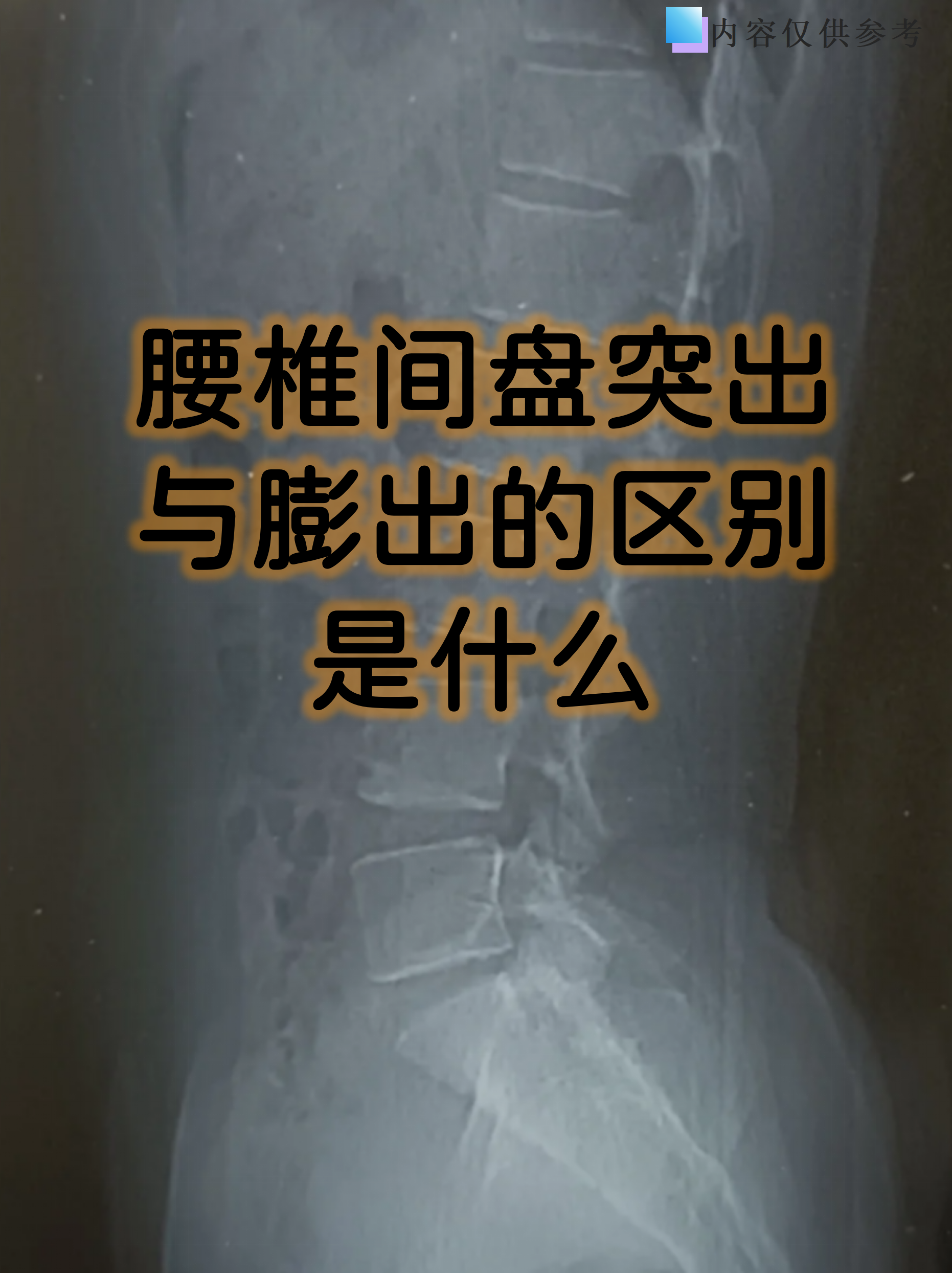 腰椎间盘突出与膨出的区别是什么