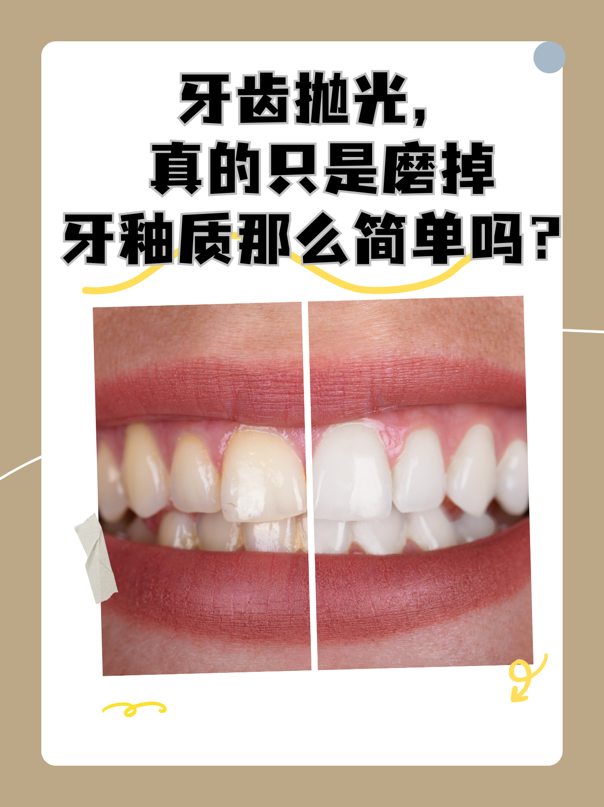 牙齿抛光,真的只是磨掉牙釉质那么简单吗?