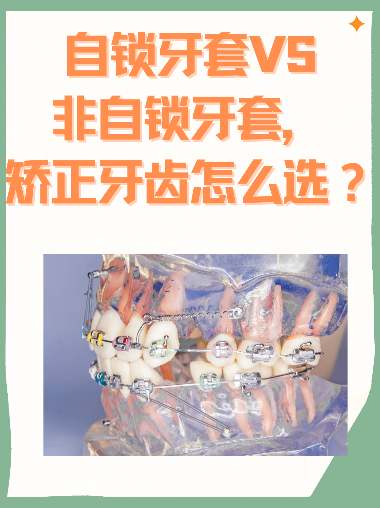 自锁牙套vs非自锁牙套,矫正牙齿怎么选?