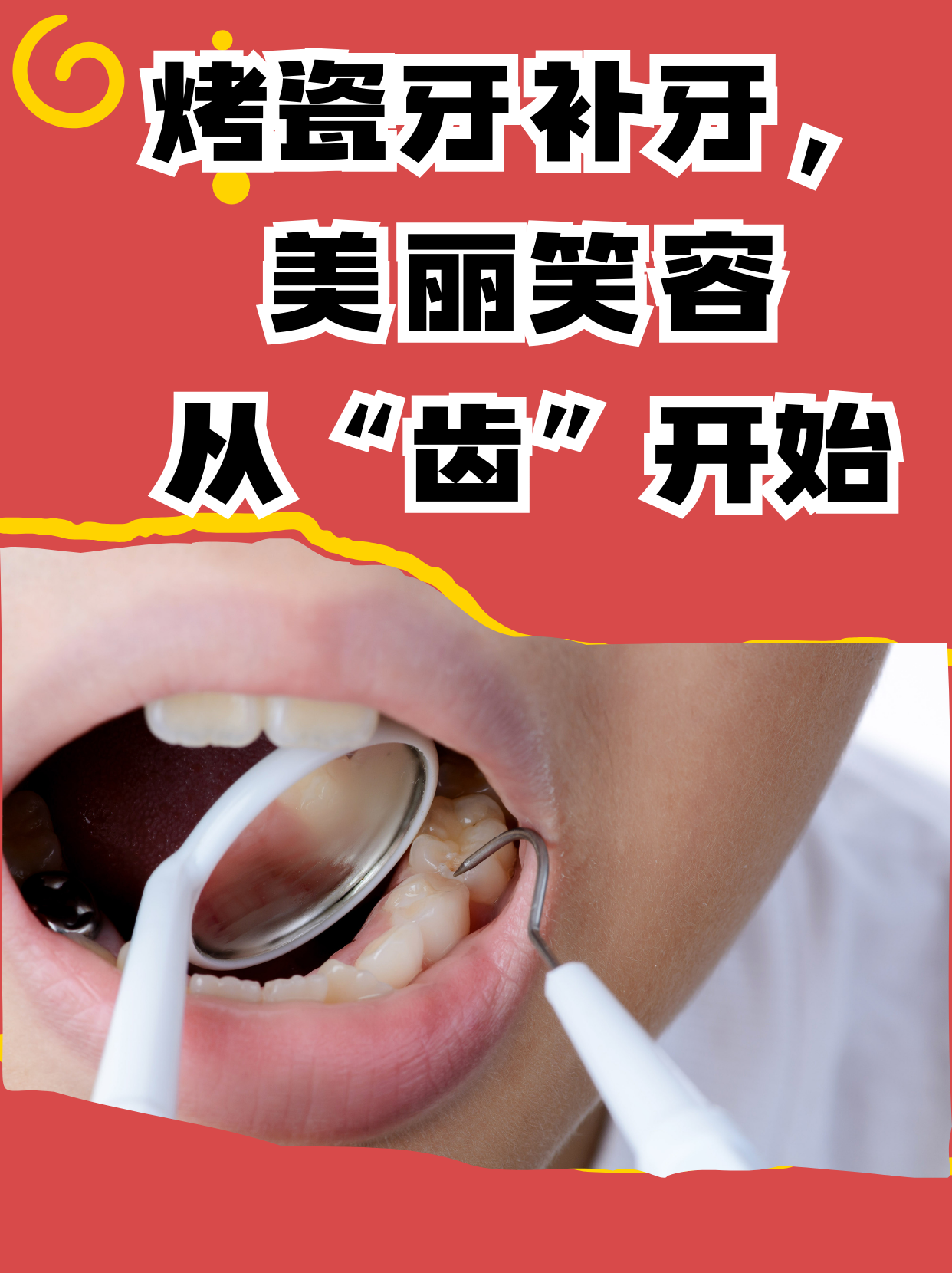 补牙为什么要戴牙套 补牙为什么要戴牙套