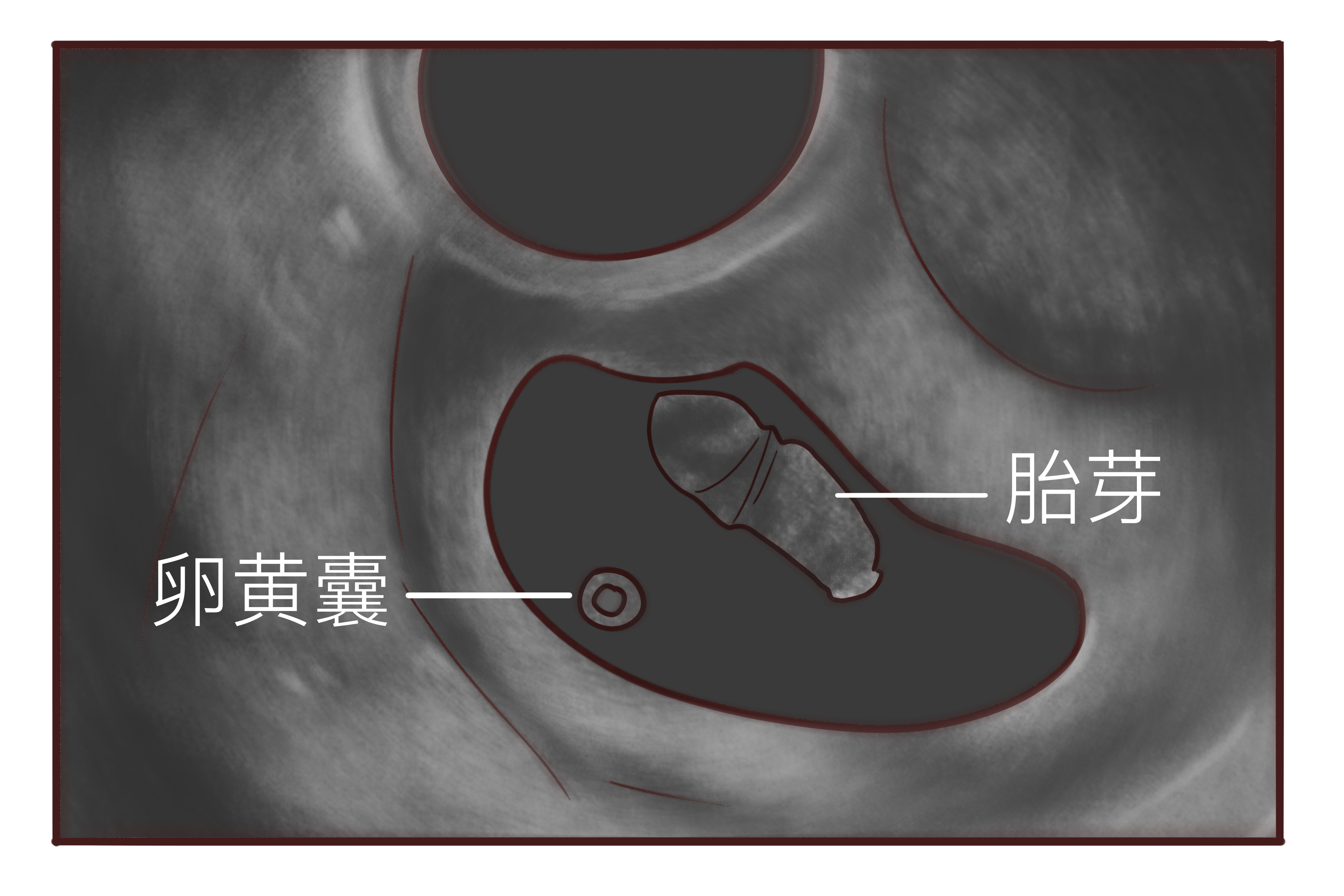 生化妊娠流产要超度-生化妊娠流产流血颜色