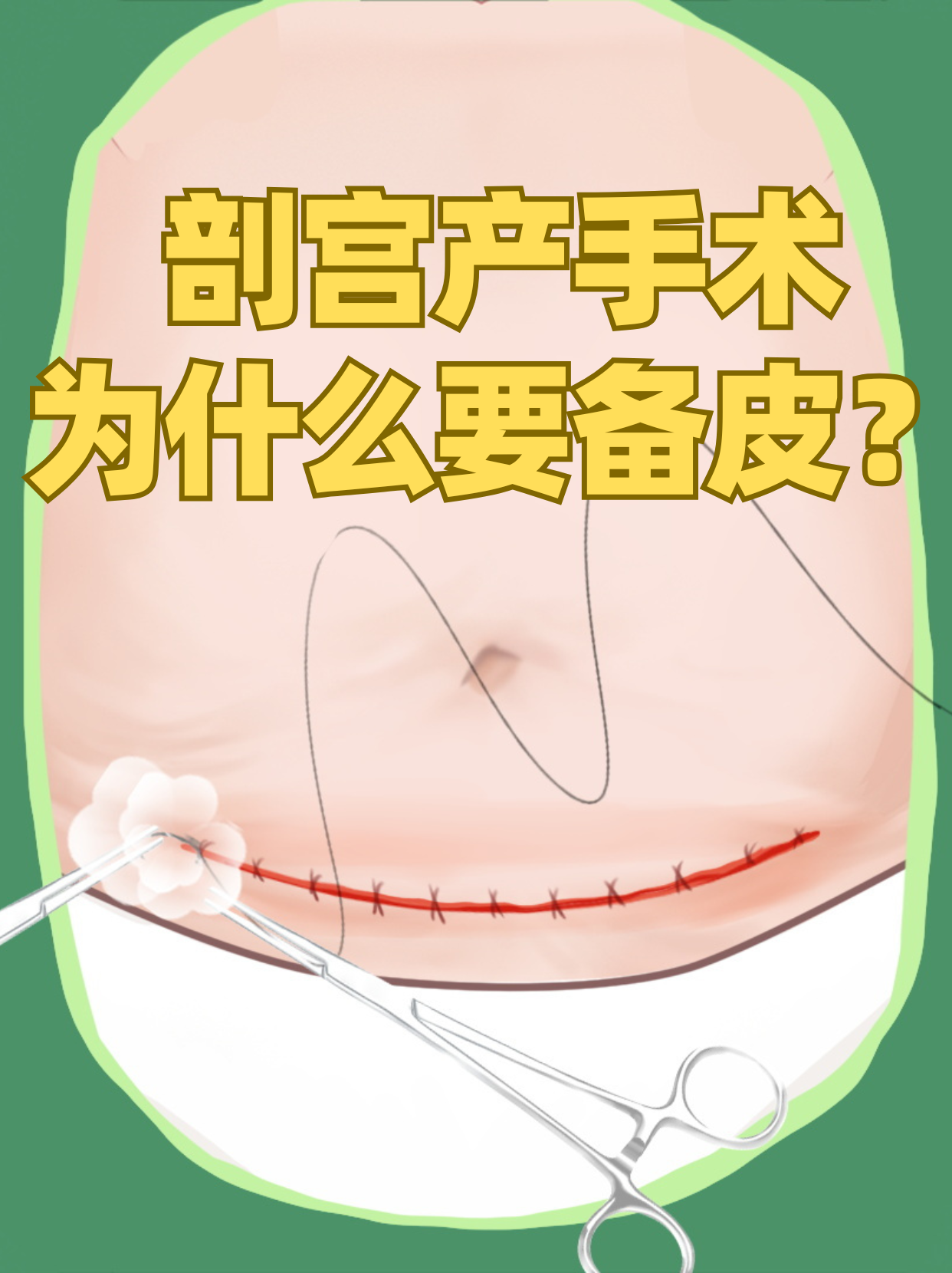 我现在孕晚期,看网上的帖子,都说剖宫产之前得备皮,但剖宫产是切