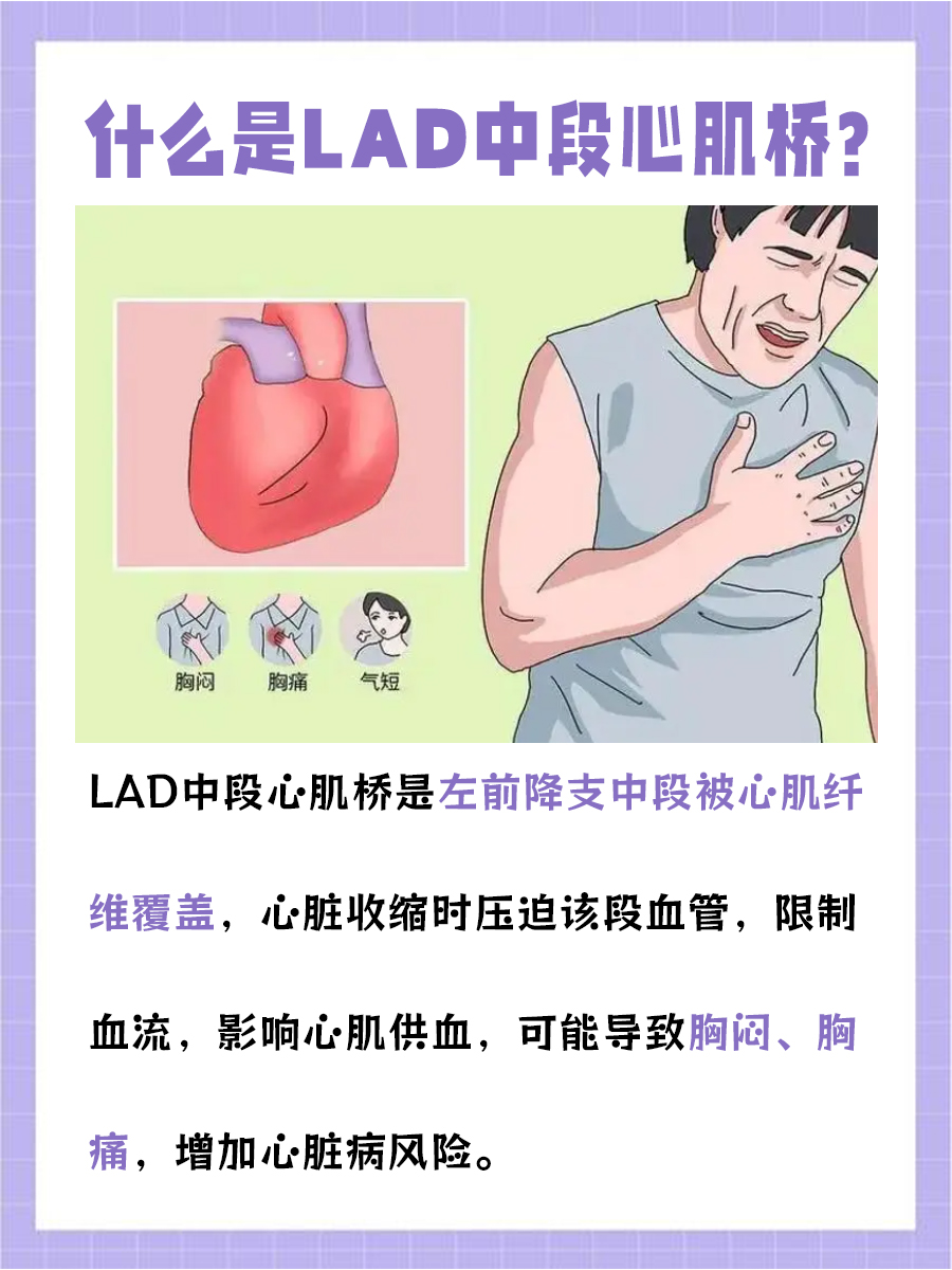 lad中段心肌桥:了解这一潜在的心脏健康威胁
