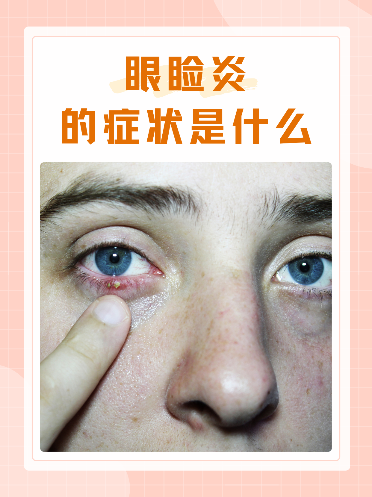 眼睑炎主要发生在眼睑的边缘部位,它可能是由于细菌,真菌的感染