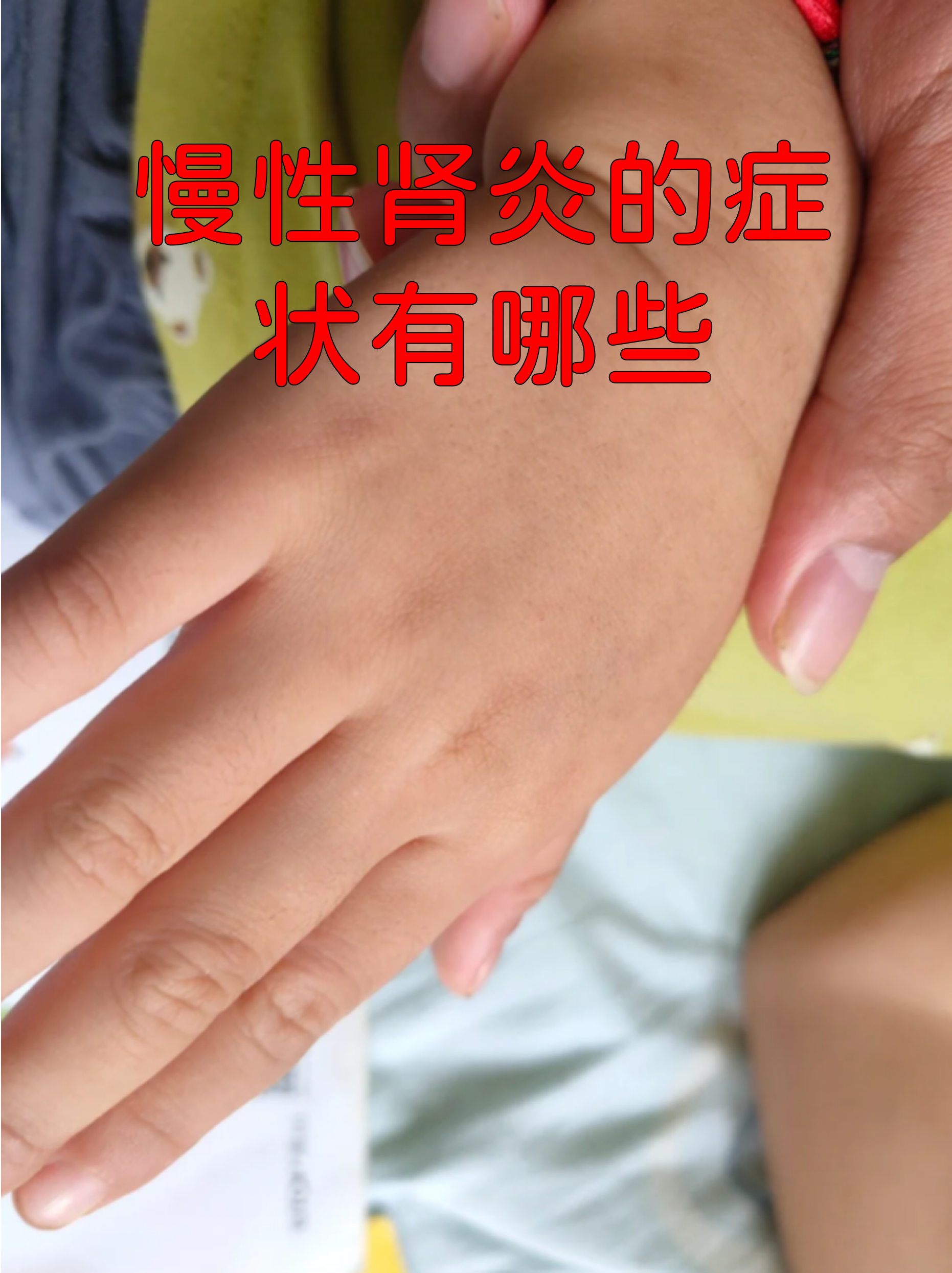 慢性肾炎五大症状 水肿:晨起眼睑或下肢浮肿,按压后凹陷恢复慢,与