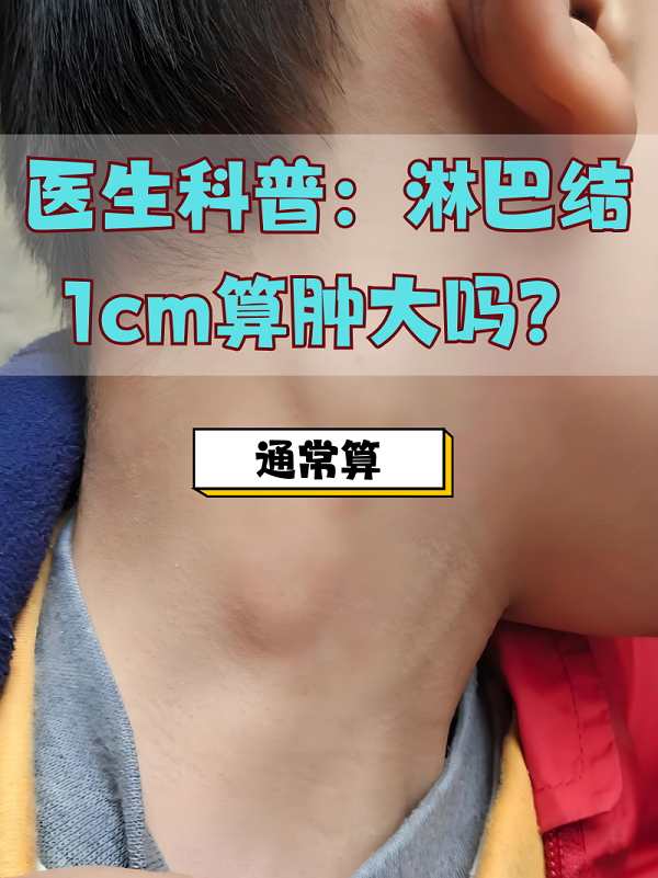 医生科普:淋巴结1cm算肿大吗?